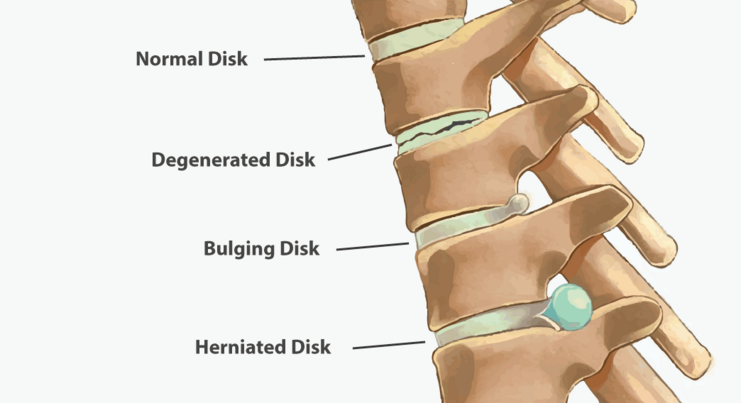 intervertebral disc herniation